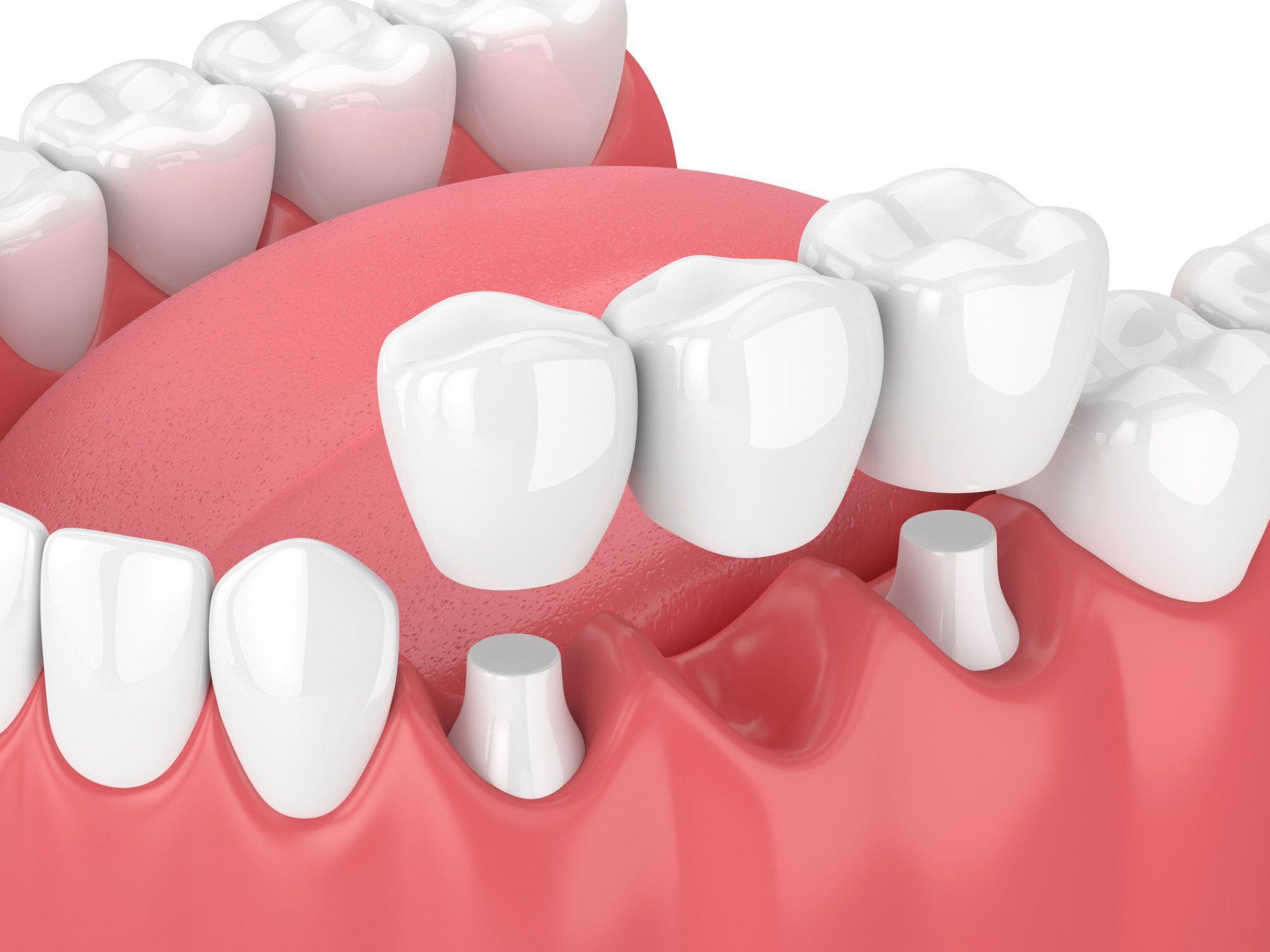 Rendered Photo of a Dental Bridge — Eastpointe, MI — Eastland & Professional Dental Center Rendered Photo of a Dental Bridge — Eastpointe, MI — Eastland & Professional Dental Center