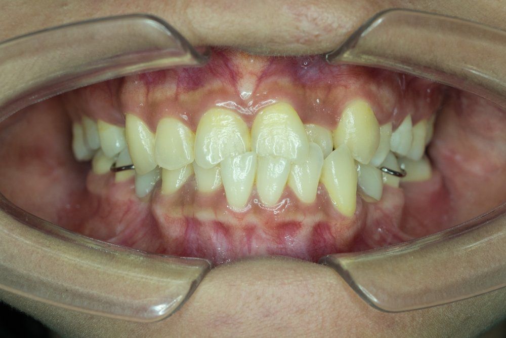 Dr. Young Nam Kim Orthodontist | What is a crossbite
