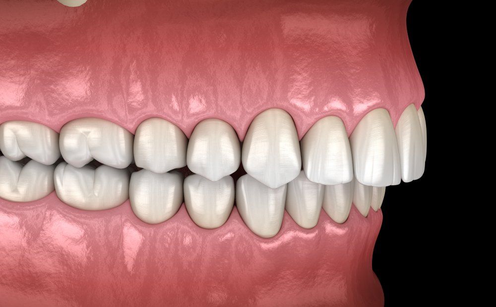 Dr. Young Nam Kim Orthodontist | What is an overbite