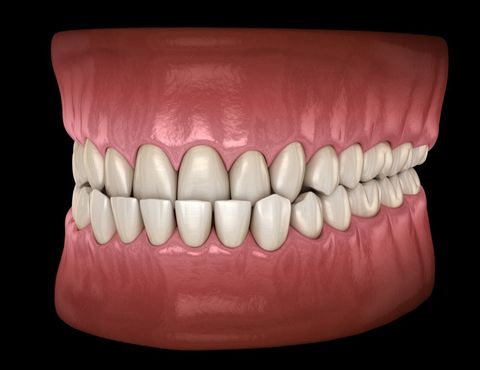 Dr. Young Nam Kim Orthodontist | What is an underbite