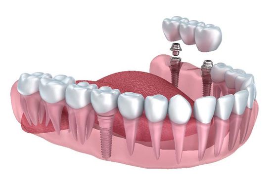 implant