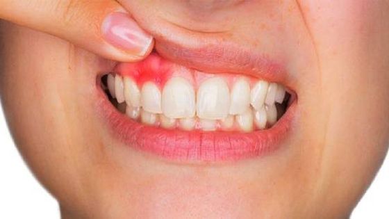 gum health