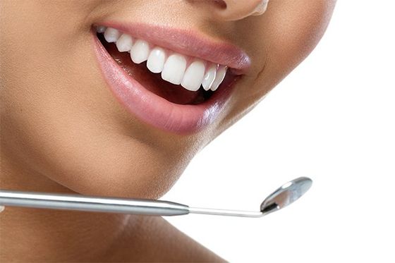 veneers