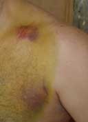 Bruised shoulder and chest