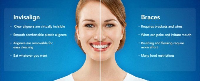 Invisalign versus Braces