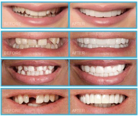 Snap-On Smile