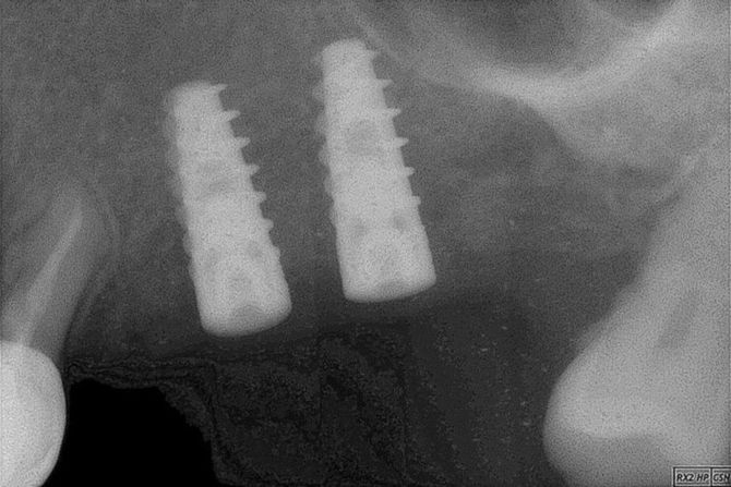 Impianti dentali
