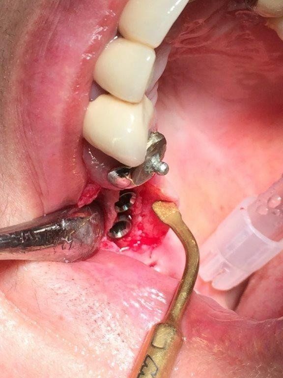 Inserimento impianti dentali
