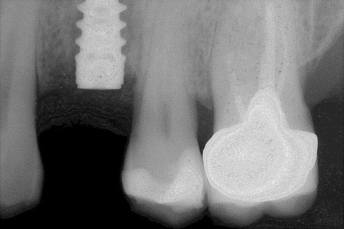 Radiografia impianto dentale