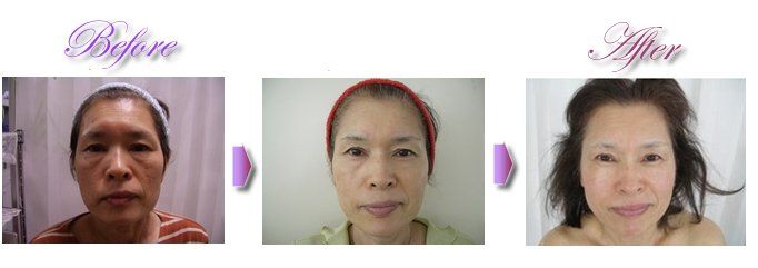 フェイシャルのビフォー・アフター