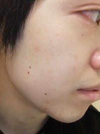 フェイシャルのアフター