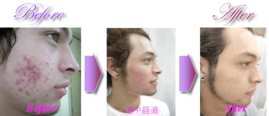 フェイシャルのビフォー・アフター