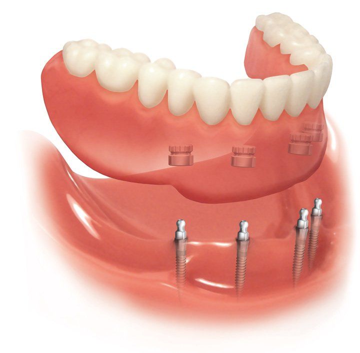 implant retained denture