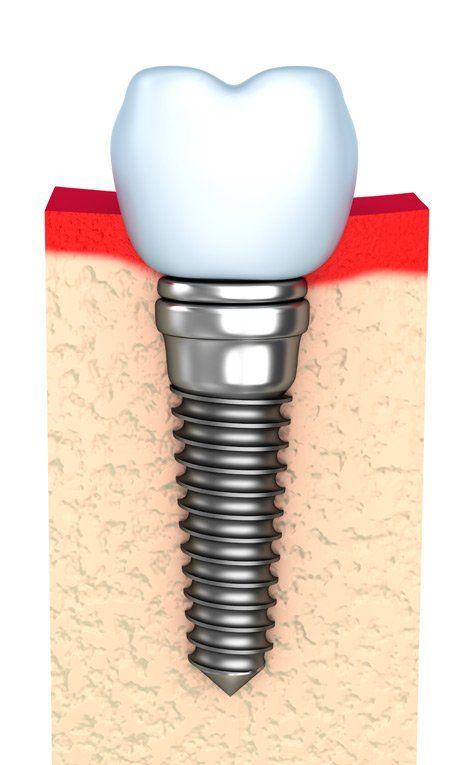 dental implant