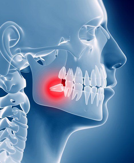 wisdom tooth illustration