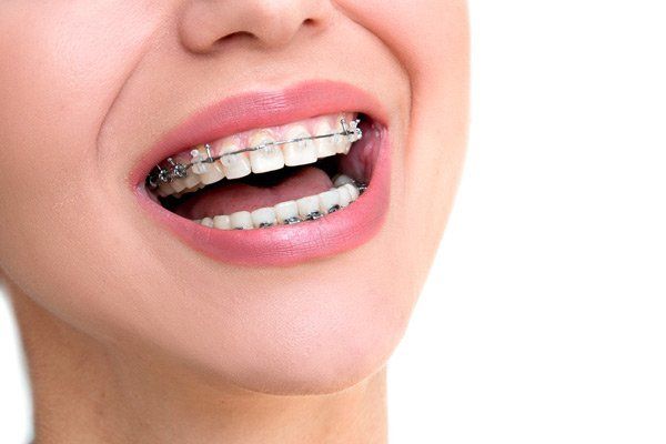 woman with clear braces