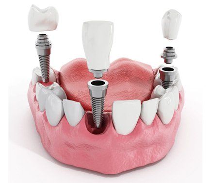dental implants