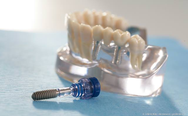 Implantate ersetzen fehlende Zähne Implantate ersetzen fehlende Zähne