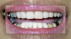 Advanced Dental Care