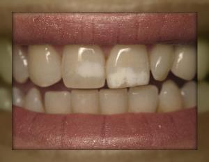 Advanced Dental Care