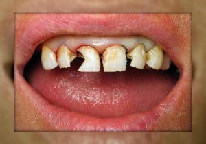 Advanced Dental Care