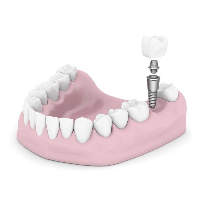 One tooth implant one tooth implant
