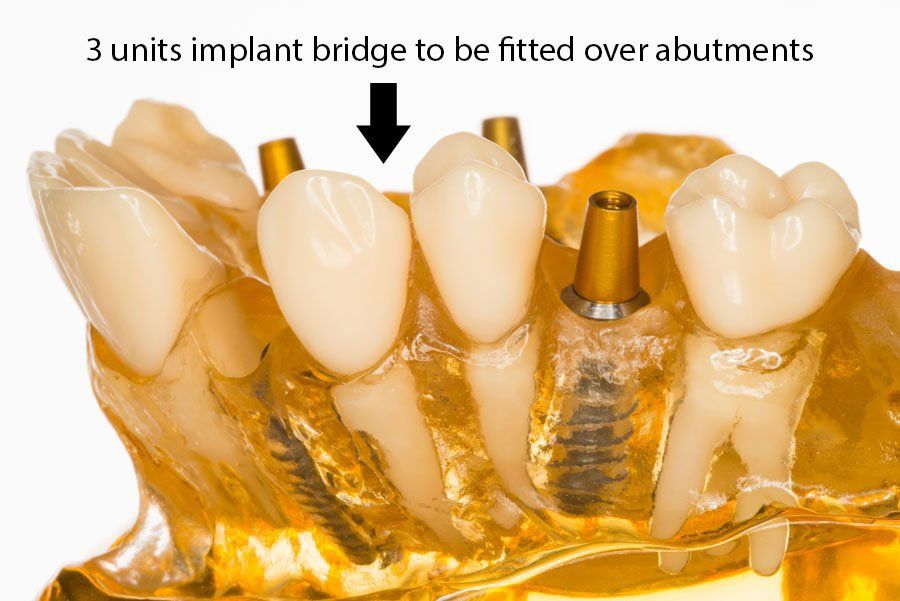 Restored with 2 more unit implant crowns restored with 2 more unit implant crowns