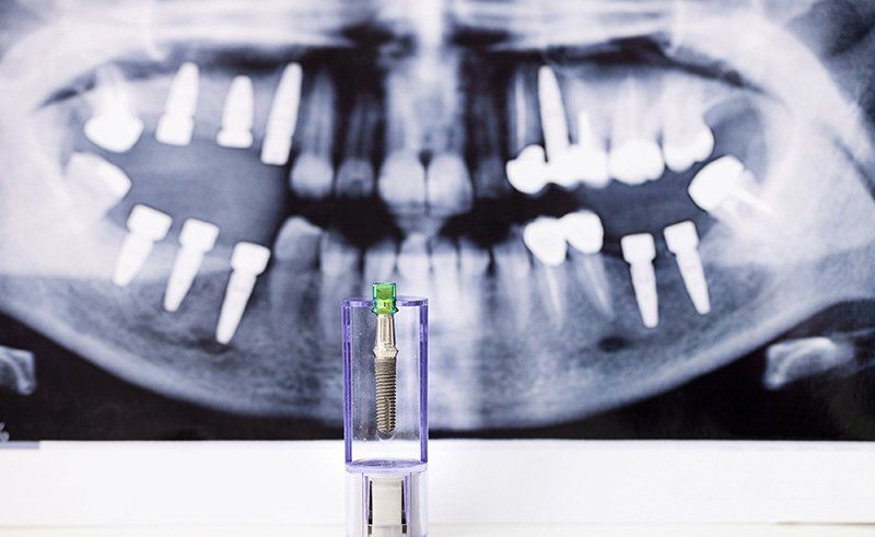 xray of teeth in mouth