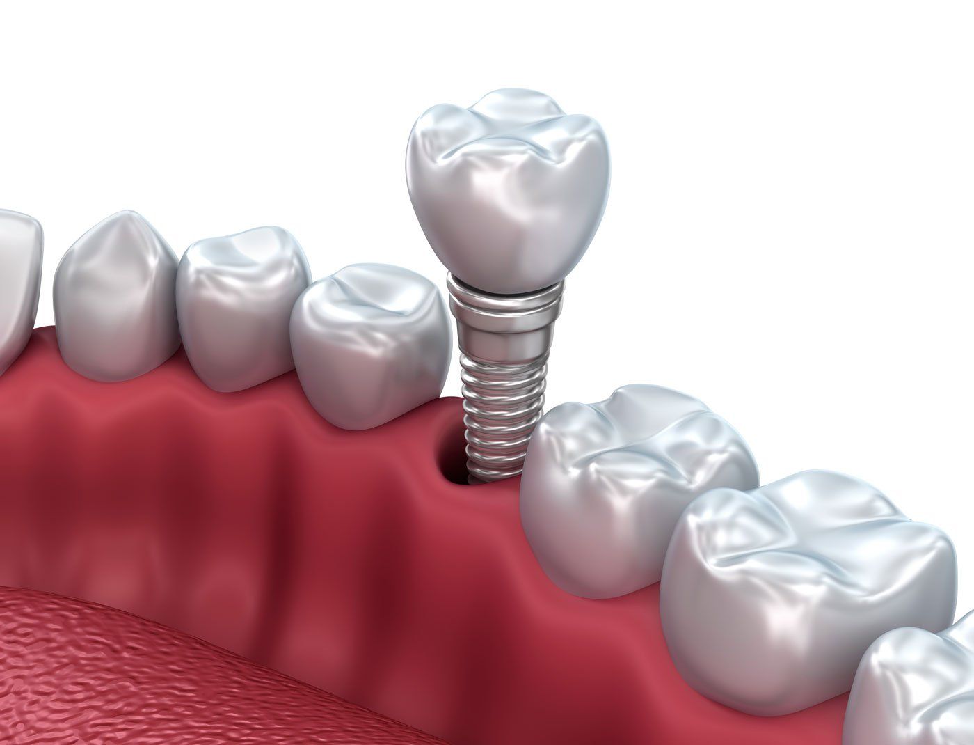 Dental implants dental implants