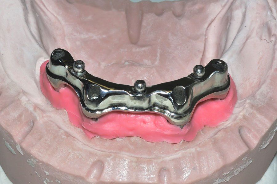 Lower implant framework lower implant framework