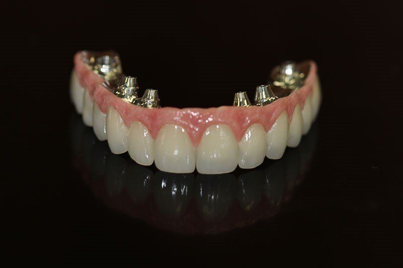 Full upper fixed bridge supported by b units full upper fixed bridge supported by 6 units