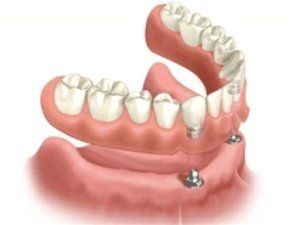 Full upper overdenture supported by 2 units implants full upper overdenture supported by 2 units implants