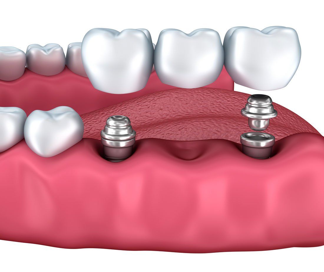 3 unit implants supported bridge using 2 unit implants 3 unit implants supported bridge using 2 unit implants