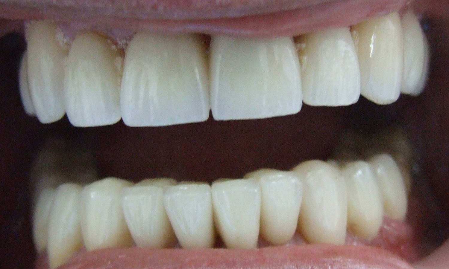 Severely worn teeth after treatment severely worn teeth after treatment