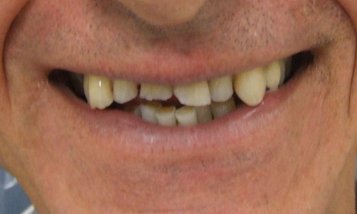 Before porcelain veneer before porcelain veneer