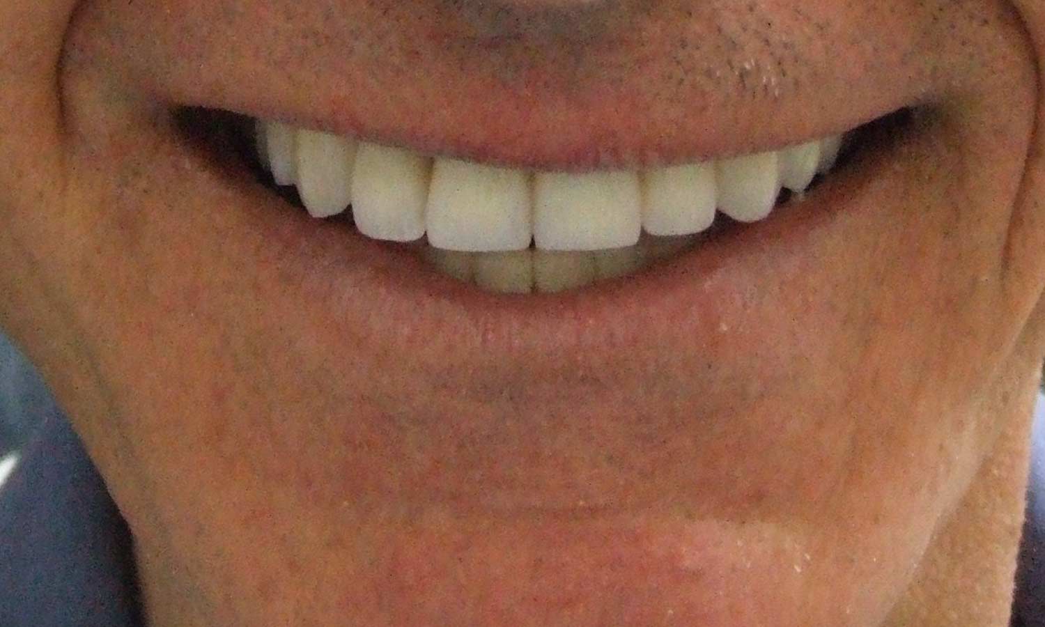 After porcelain veneer after porcelain veneer