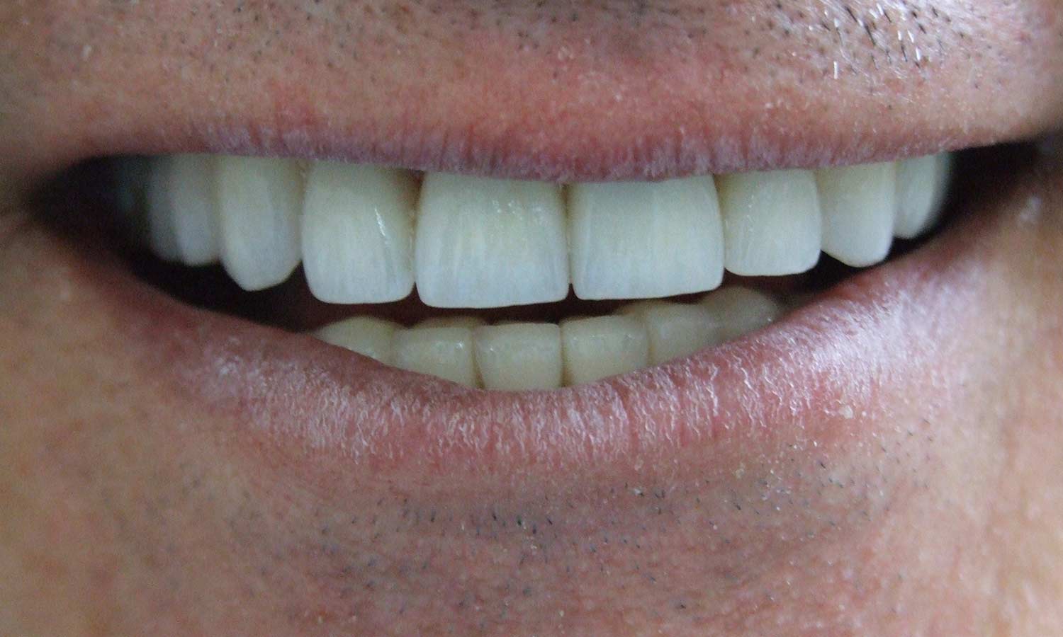 Porcelain veneer porcelain veneer