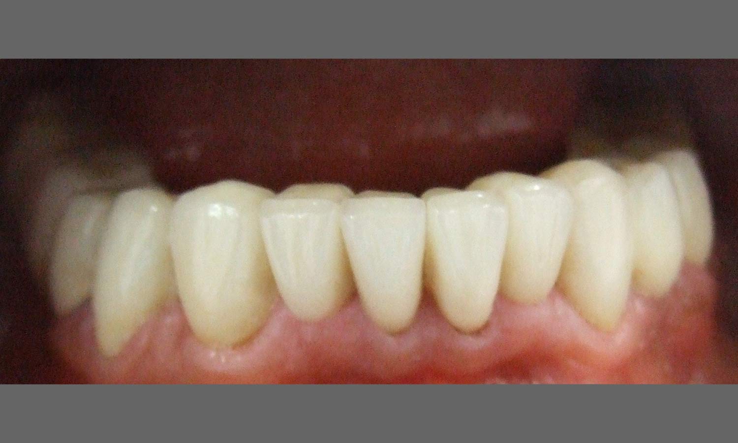 Porcelain veneer after image porcelain veneer after image
