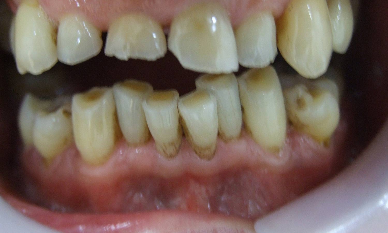 Severely worn teeth before treatment severely worn teeth before treatment