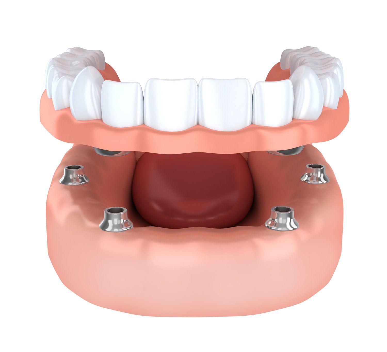 Full upper overdenture supported by 4 units implants full upper overdenture supported by 4 units implants