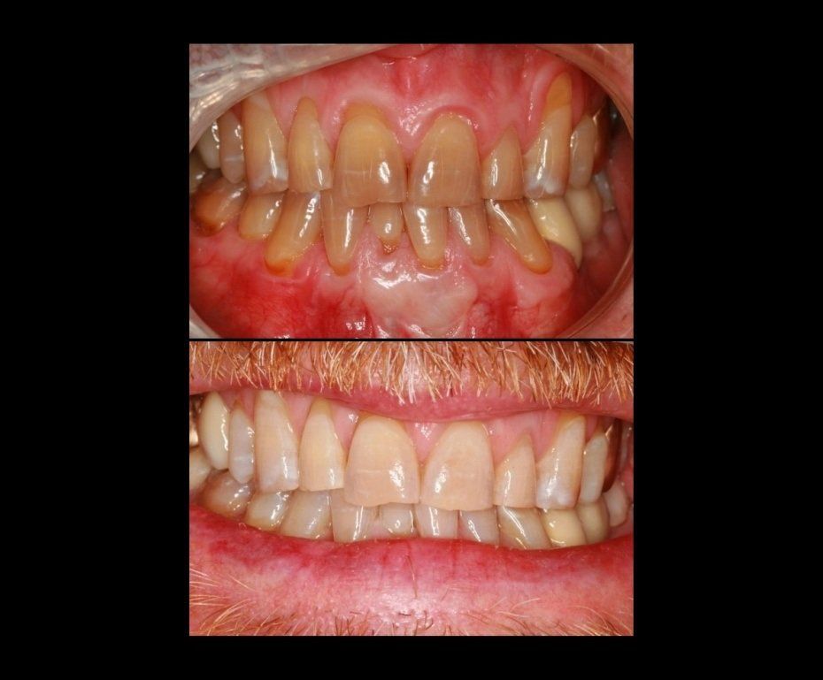 Whitening