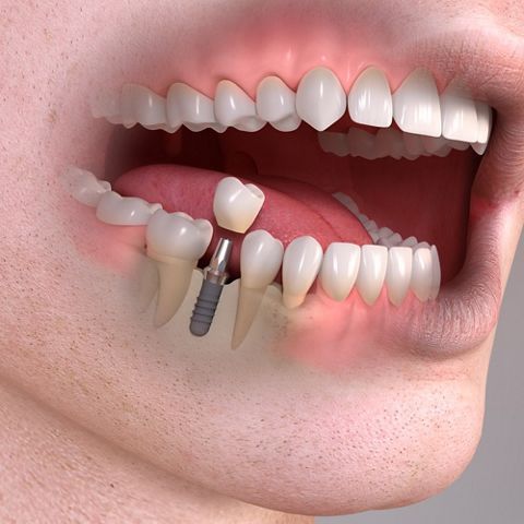 Dental Implants Eagle River,  AK