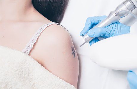 tattoo removal