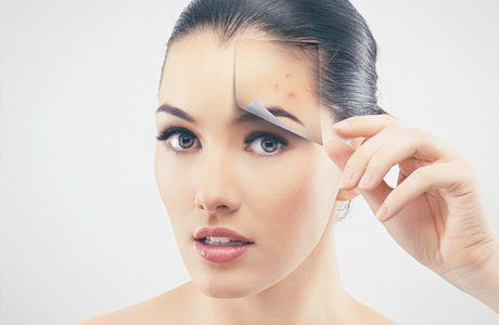 IPL treatment 1