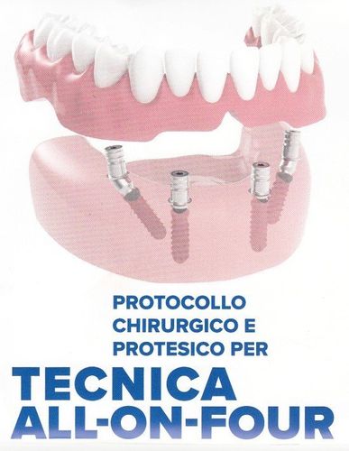 figura di un impianto dentale