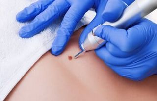 Warts — Skin Getting Treated in Slidell, LA