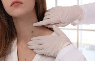Abnormal Moles — Mole Getting Checked by a Dermatologist in Slidell, LA