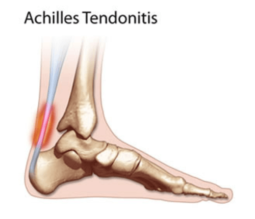Achilles Tendonitis photo