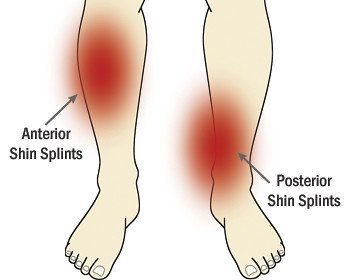Comparison of Anterior Shin Splints and Posterior Shin Splints