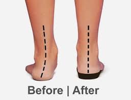 Orthotics Plymouth